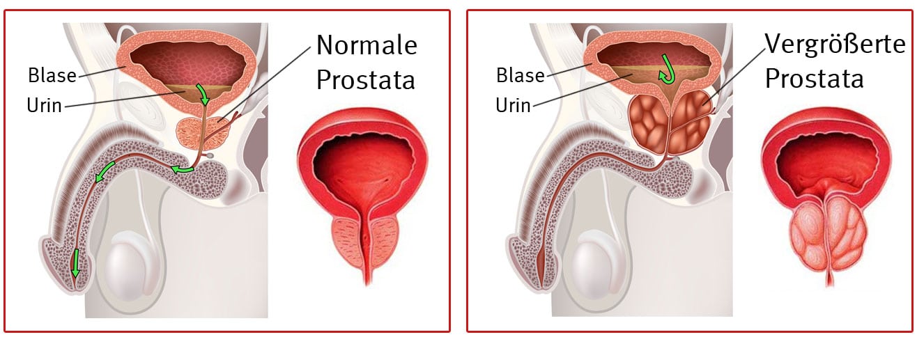 Prostatahypertrophie